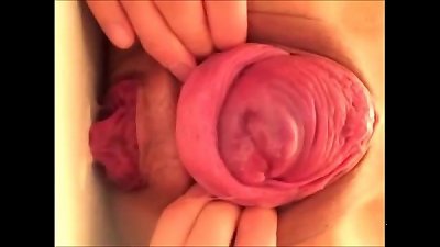 Proper treatment of prolapse of the anus can be done through sex